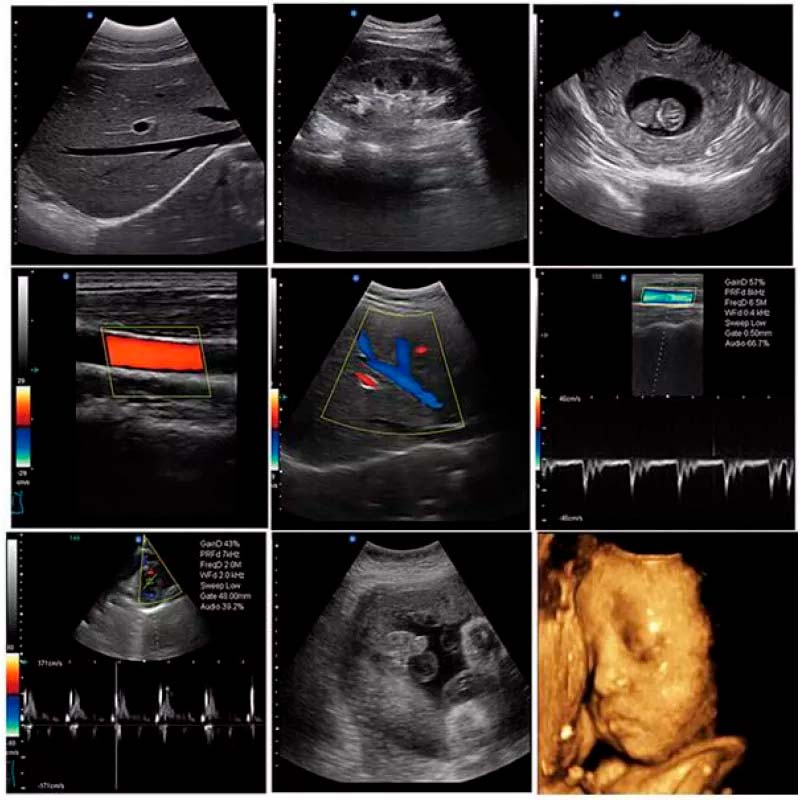 Unveiling the Power of Ultrasound: The Kalstein Ultrasound Scanner Experience